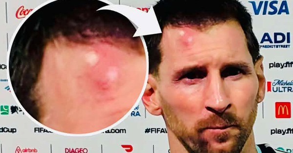 Messi sưng vêu trán sau trận thắng Cabo Verde: Vì sao nên nỗi? - hình ảnh - f8betv.vip